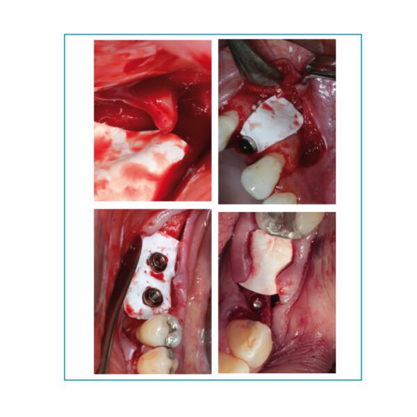 Surgitime PTFE 0,25 mm formato H