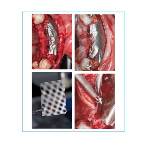 Surgitime Titanio 0,15mm