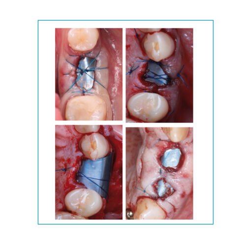 Surgitime Titanio Seal