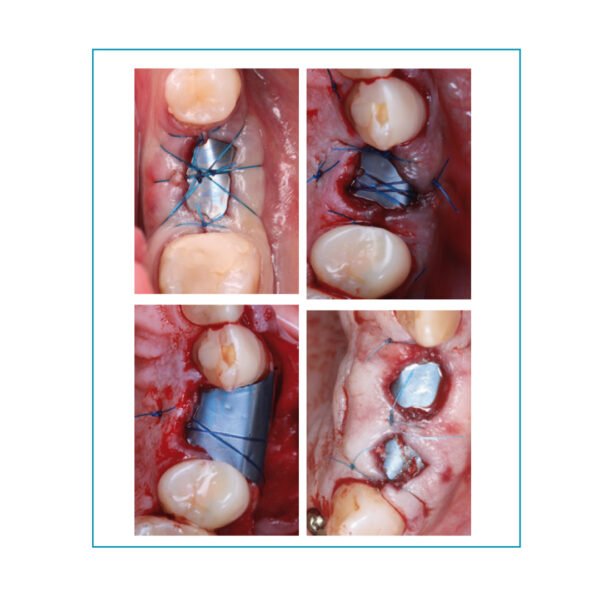 Surgitime Titanio Seal